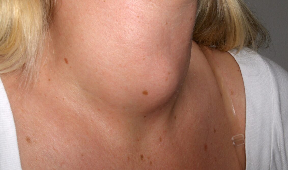 thyroiditis on a woman