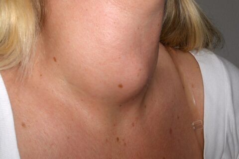 thyroiditis on a woman