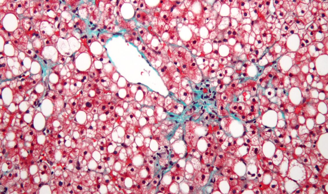 Fatty Liver Disease . Red, Blue, and White Coloring